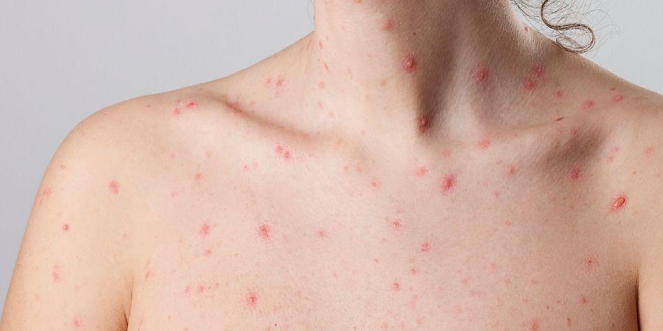 El Gobierno porteño advirtió sobre la viruela del mono