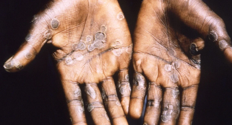 La OMS declaró la emergencia sanitaria internacional por el brote de virus del mono